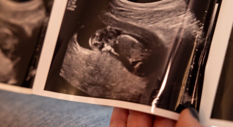 Sarah Webb-Esra holds the ultrasound photos from her pregnancy with her son Cooper Esra. During this pregnancy she developed health complications, including gestational diabetes. Today her son is a health 12-year-old boy.